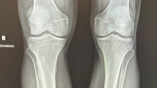 Both Leg X-ray
